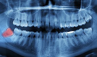 What do you know really know about your wisdom teeth?