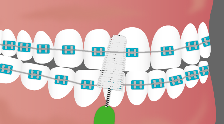 Braces can cause changes in the mouth that can look like gums growing over your braces! Click to learn about gum inflammation and swollen gums with braces.