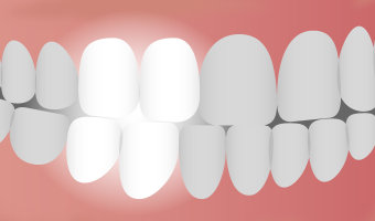 The bicuspid tooth is sometimes called a premolar because of its positioning between the canine teeth and molars.