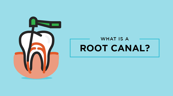 Root canal treatment: What is a root canal and why is it done?￼