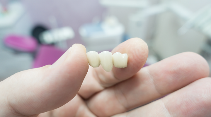 What is a dental bridge? What is a dental bridge procedure? What types of dental bridges are there? Get answers to these and many more questions in this informational dental bridge article.